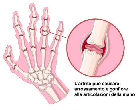 l'artrite può causare la perdita di forza nella mano