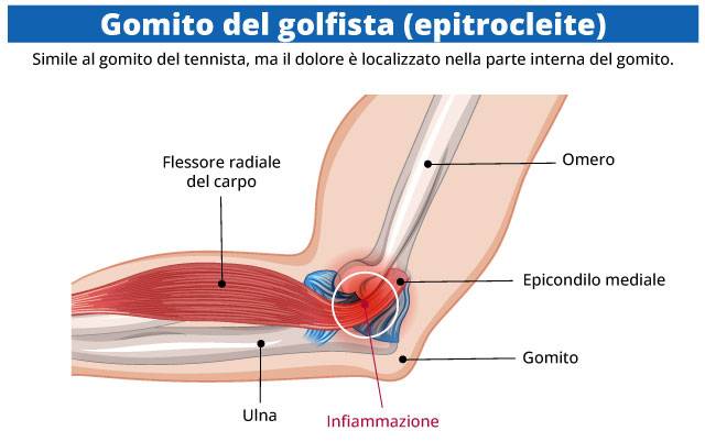 infografica epitrocleite gomito del golfista