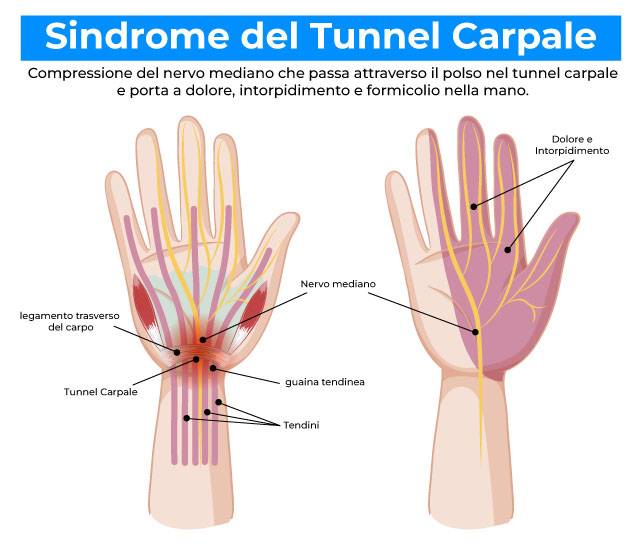 infografica anatomica tunnel carpale